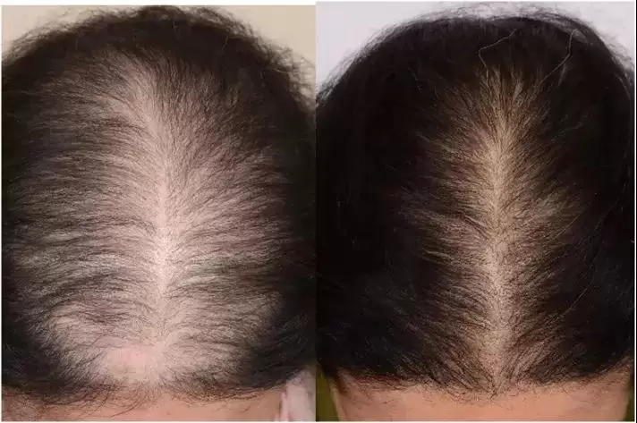 prp treatment