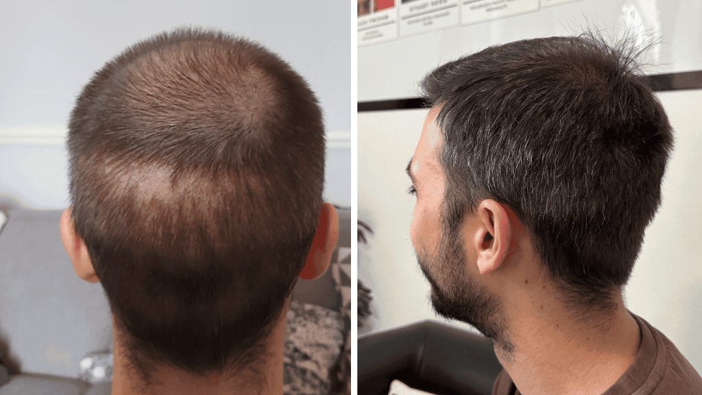 prp results